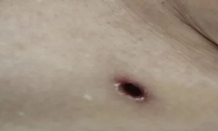 Phát Hiện Suy Đa Tạng Sau Khi Xuất Hiện “Dấu Vết Lạ” Trên Da