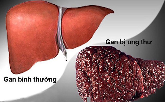 WHO cảnh báo chất gây ung thư nguy hiểm "ẩn mình trong các món hàng ngày của người Việt"