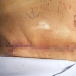 Hút mỡ nguy hiểm: những rủi ro tiềm ẩn chết người