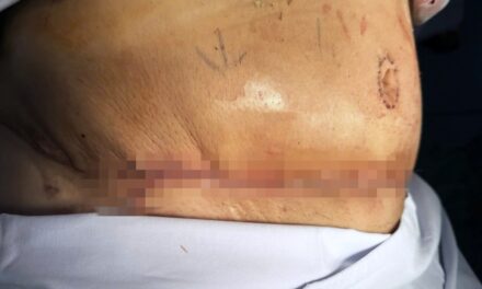 Hút mỡ nguy hiểm: những rủi ro tiềm ẩn chết người