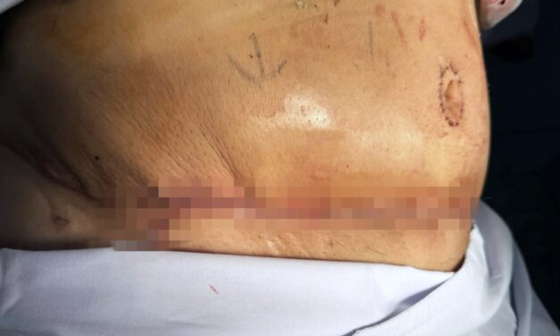 Hút mỡ nguy hiểm: những rủi ro tiềm ẩn chết người