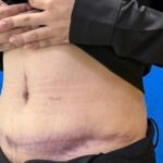 Mũi tiêm trị sẹo làm biến dạng bụng sau hút mỡ