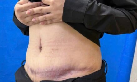 Mũi tiêm trị sẹo làm biến dạng bụng sau hút mỡ