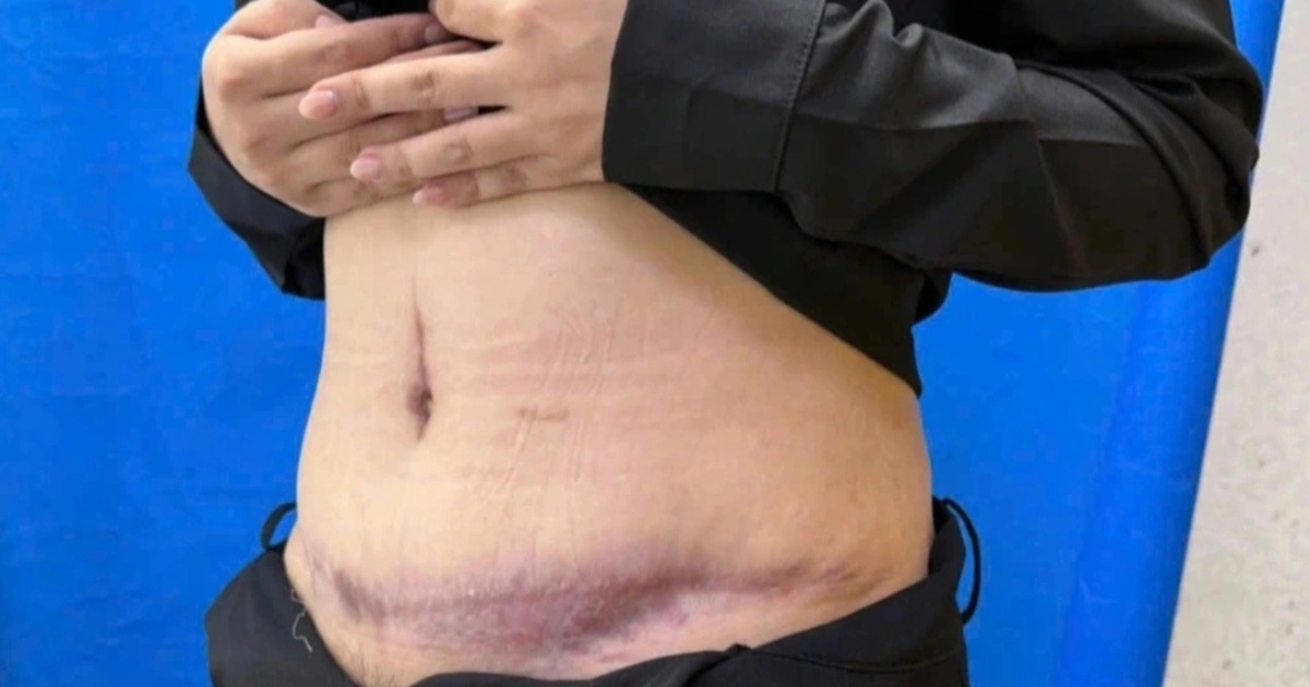 Mũi tiêm trị sẹo làm biến dạng bụng sau hút mỡ